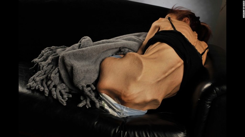 psychodietetyka leczenie anoreksja bulimia kompulsywne objadanie ośrodek zamknięty stacjonarny mazowieckie warszawa grodzisk mazowiecki filar